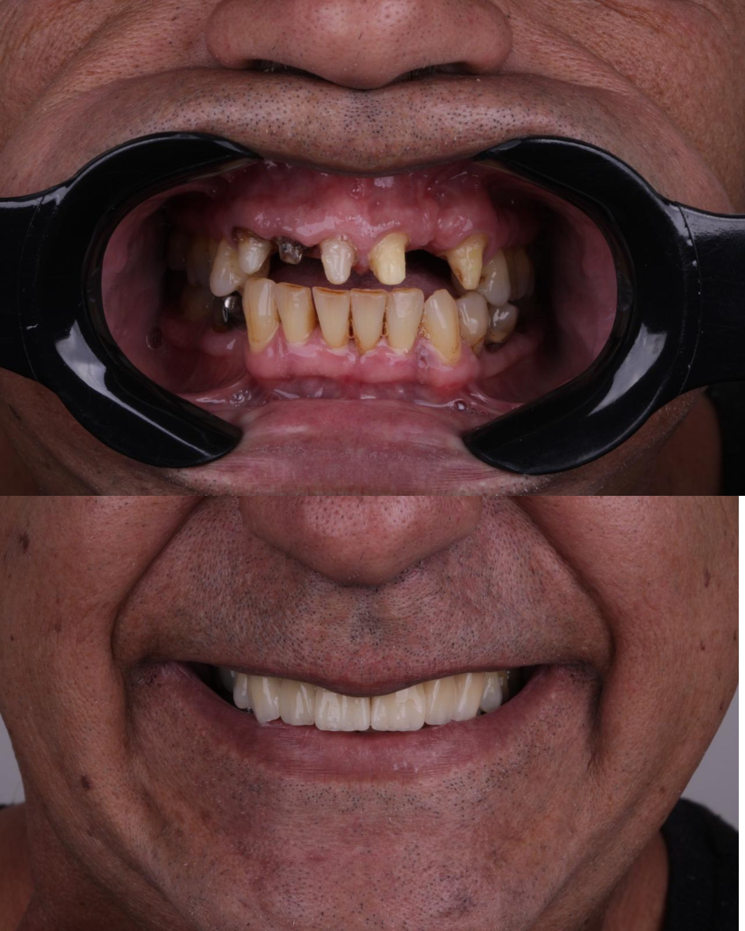 Implantes e Próteses (1)