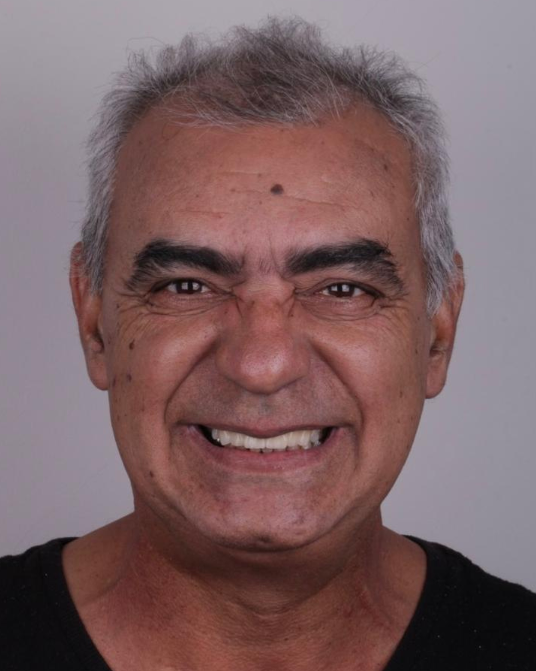 Implantes e Próteses (3)