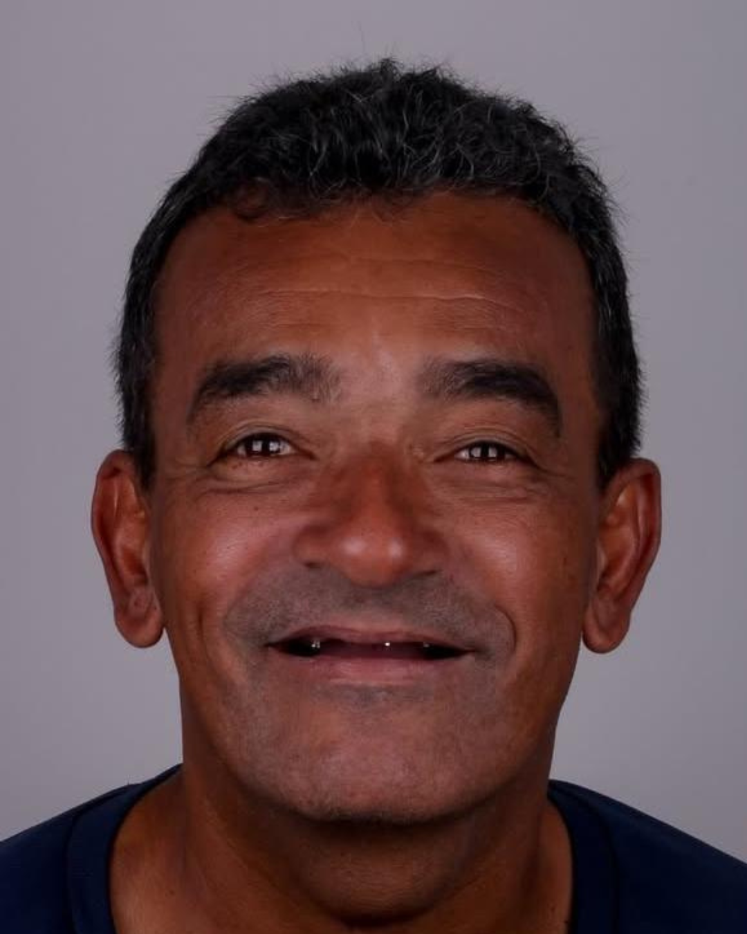 Implantes e Próteses (8)