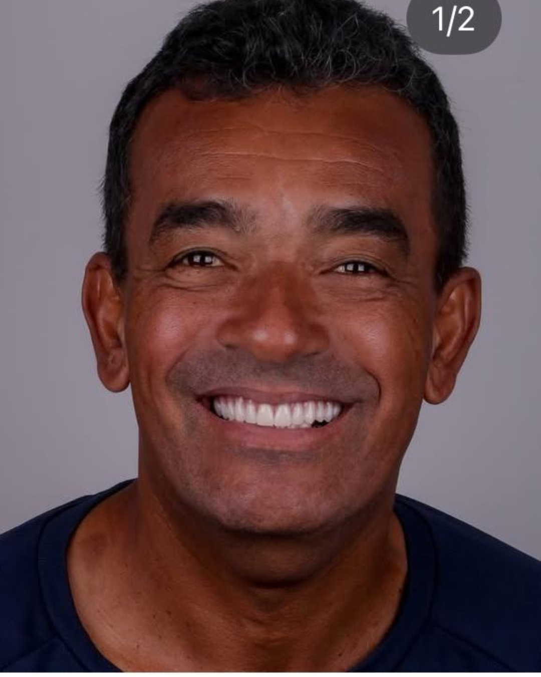 Implantes e Próteses (9)