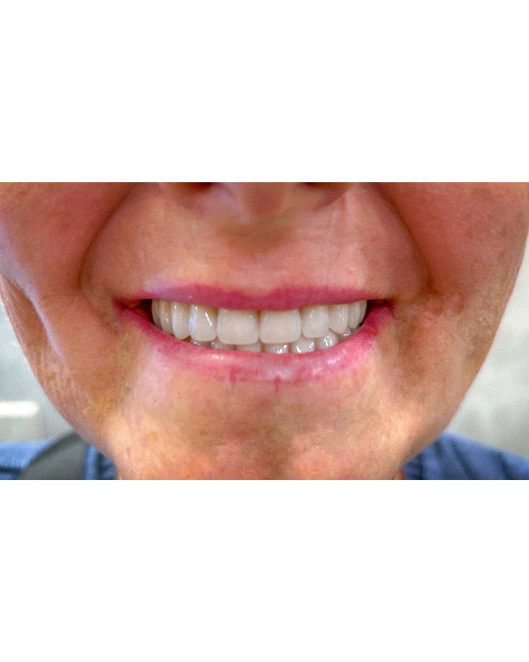 Lentes ImplanTOP (1)