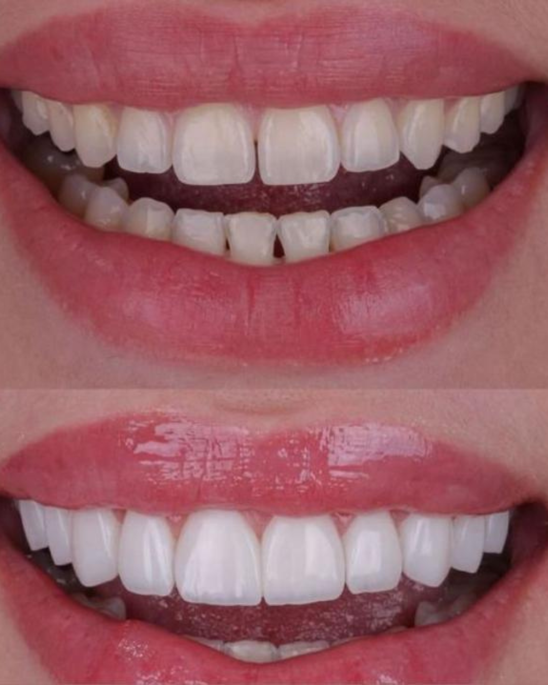 Lentes ImplanTOP (3)